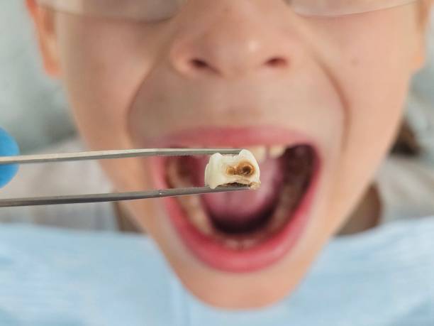 Best Emergency Dentist for Knocked-Out Tooth in St Andrews, SC